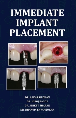 Immediate Implant Placement - Dr Aadarsh Dhan