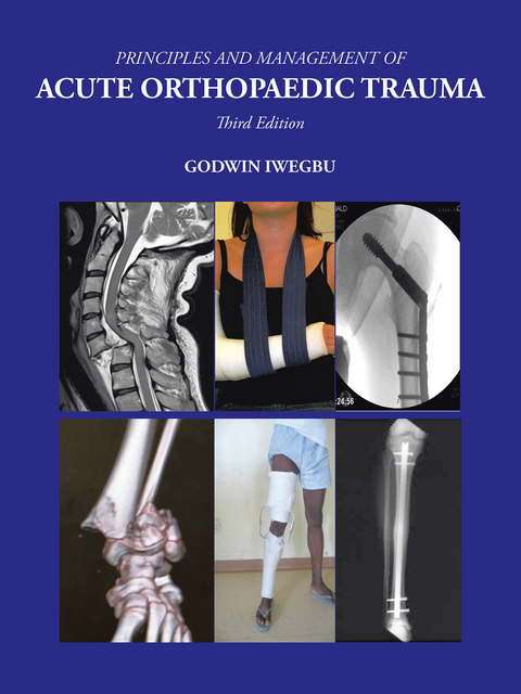 Principles and Management of Acute Orthopaedic Trauma - Godwin Iwegbu