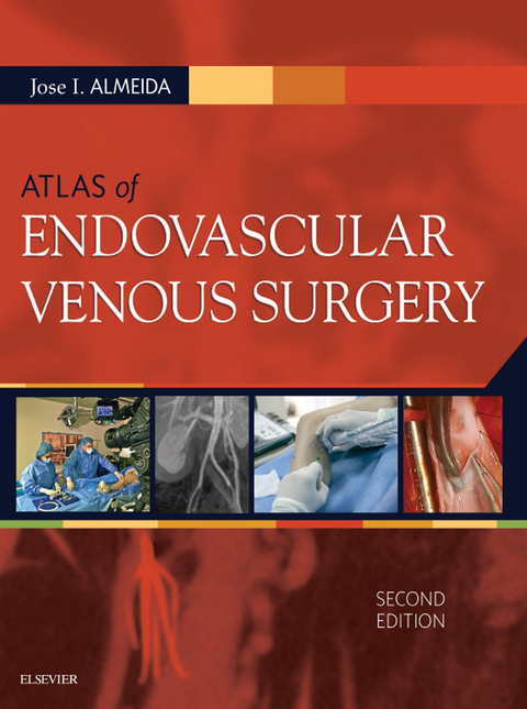 Atlas of Endovascular Venous Surgery E-Book -  Jose Almeida