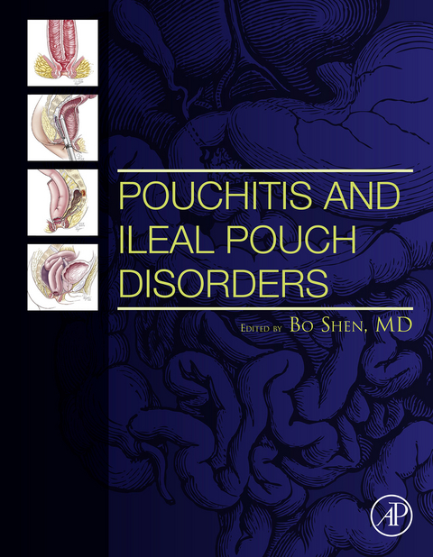 Pouchitis and Ileal Pouch Disorders - 