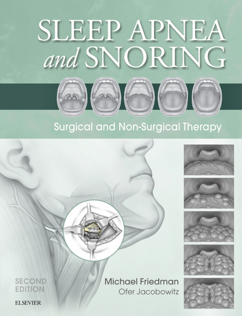 Sleep Apnea and Snoring E-Book - 