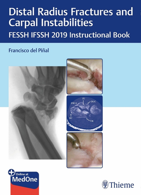 Distal Radius Fractures and Carpal Instabilities - 