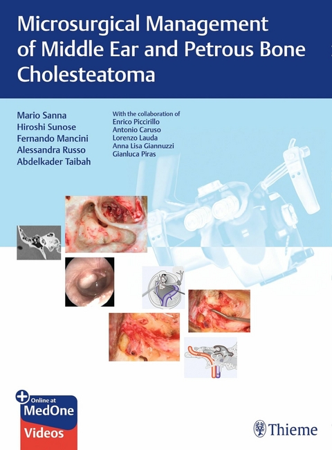 Microsurgical Management of Middle Ear and Petrous Bone Cholesteatoma - Mario Sanna, Hiroshi Sunose, Fernando Mancini, Alessandra Russo, Abdelkader Taibah