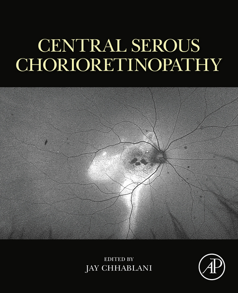 Central Serous Chorioretinopathy - 