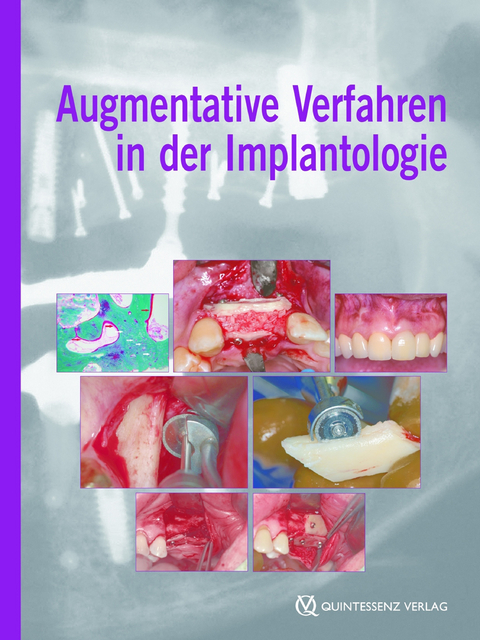 Augmentative Verfahren in der Implantologie - Fouad Khoury