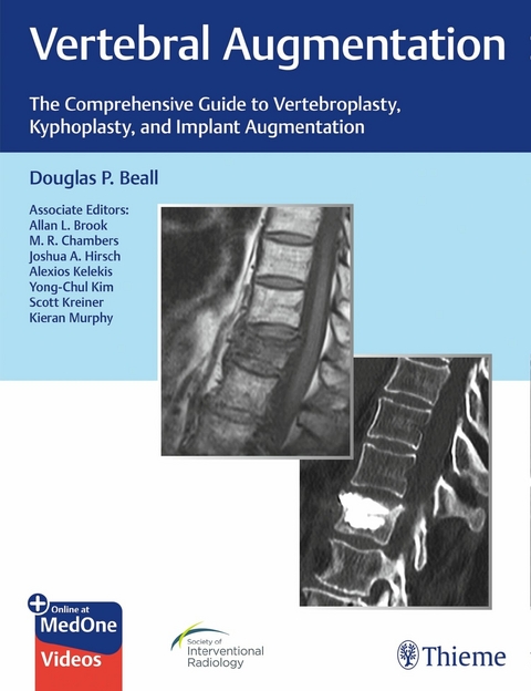 Vertebral Augmentation -  Douglas P. Beall