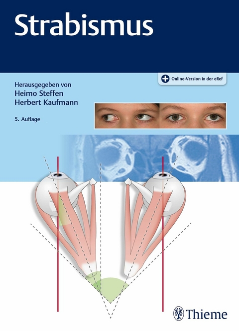 Strabismus - 