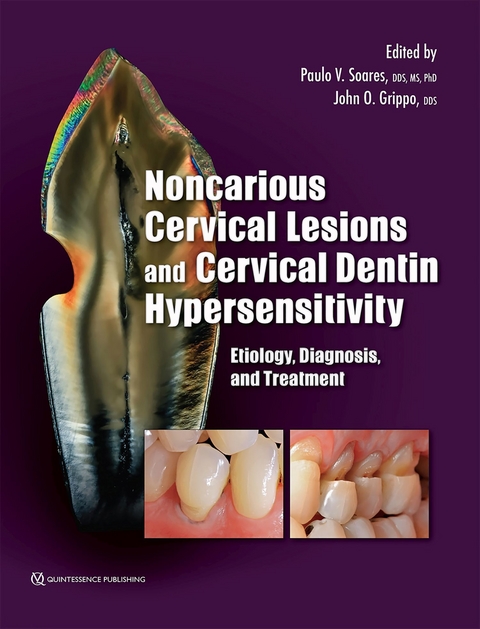 Noncarious Cervical Lesions and Cervical Dentin Hypersensitivity - Paulo V. Soares, John O. Grippo