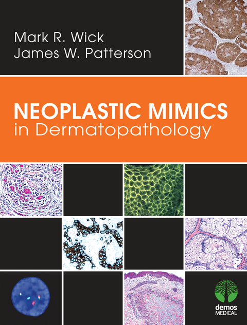 Neoplastic Mimics in Dermatopathology -  MD James W. Patterson,  MD Mark R. Wick