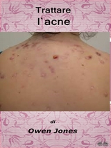 Trattare L'Acne - Owen Jones