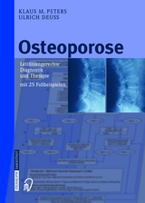 Osteoporose - Klaus M. Peters, Ulrich Deuß