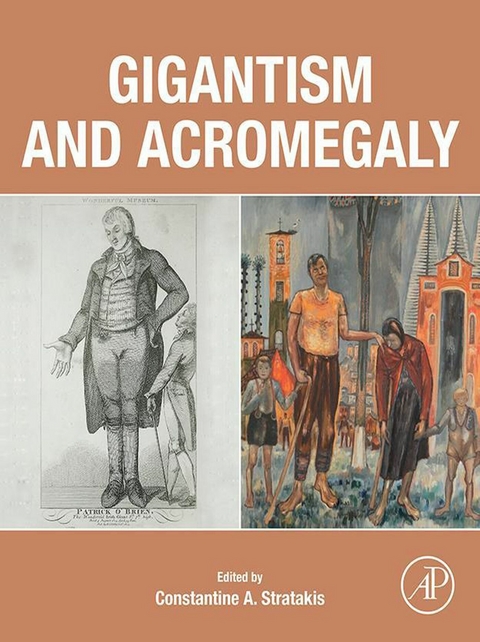 Gigantism and Acromegaly - 