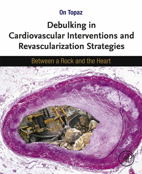 Debulking in Cardiovascular Interventions and Revascularization Strategies - 