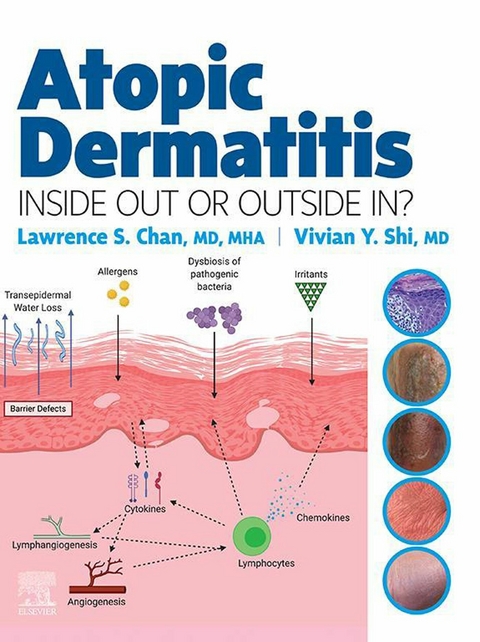 Atopic Dermatitis: Inside Out or Outside In - E-Book - 