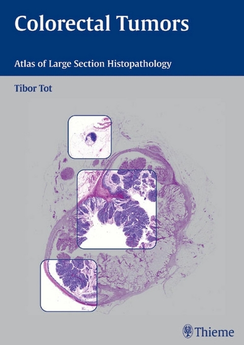 Colorectal Tumors - Tibor Tot