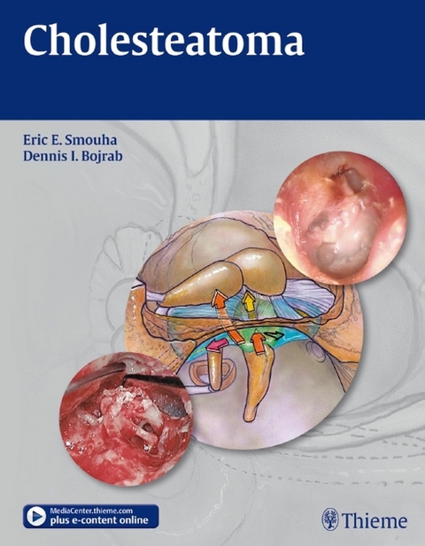 Cholesteatoma - Eric E. Smouha, Dennis I. Bojrab