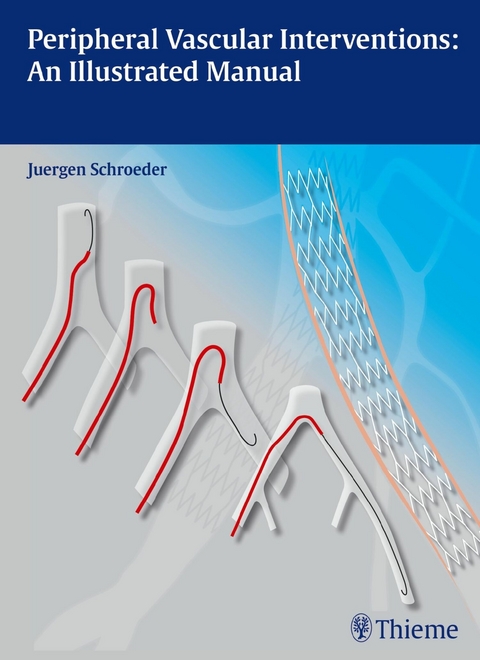 Peripheral Vascular Interventions: An Illustrated Manual -  Jürgen Schröder