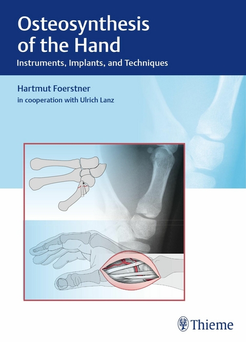 Osteosynthesis of the Hand -  Hartmut Förstner