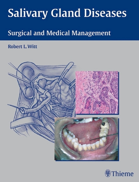 Salivary Gland Diseases - 