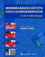 Membrangeschützte Knochenregeneration in der Implantologie - 