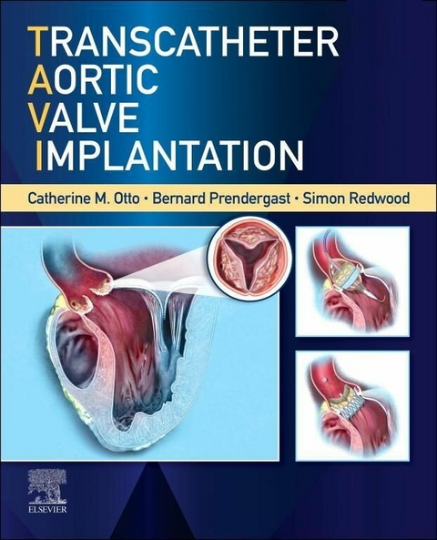 Transcatheter Aortic Valve Implantation, E-Book - 