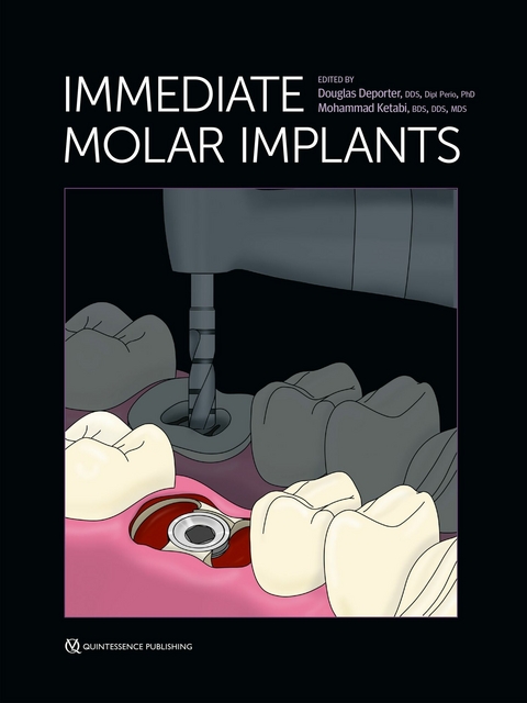 Immediate Molar Implants - Douglas Deporter, Mohammad Ketabi