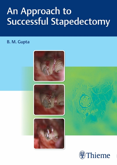 An Approach to Successful Stapedectomy -  B Gupta