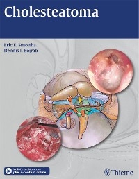 Cholesteatoma - Eric E. Smouha, Dennis I. Bojrab