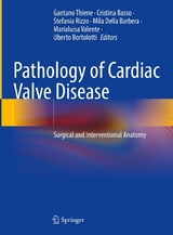 Pathology of Cardiac Valve Disease - 