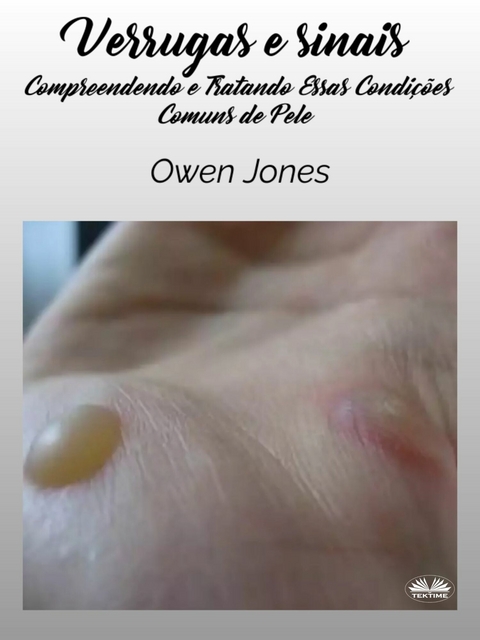 Verrugas E Sinais - Owen Jones