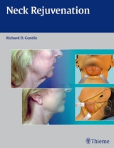 Neck Rejuvenation - 