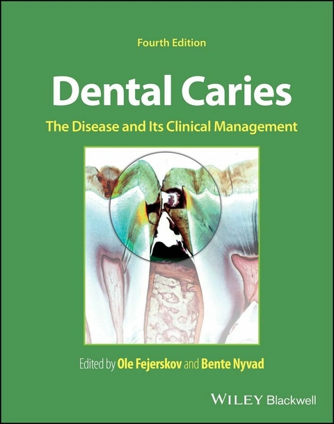 Dental Caries - 