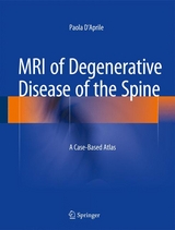 MRI of Degenerative Disease of the Spine - Paola D'Aprile