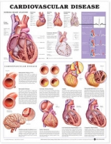 Cardiovascular Disease Anatomical Chart - 