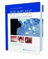 Peri-Implant Infection Etiology - Frank Schwarz, Jurgen Becker