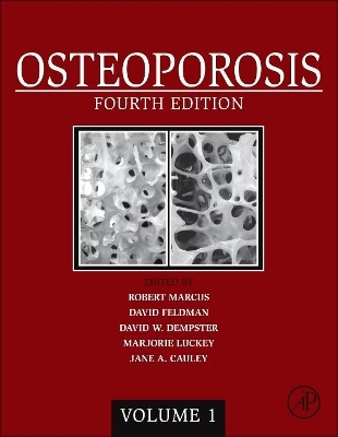 Osteoporosis - 