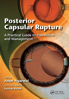 Posterior Capsular Rupture - Amar Agarwal