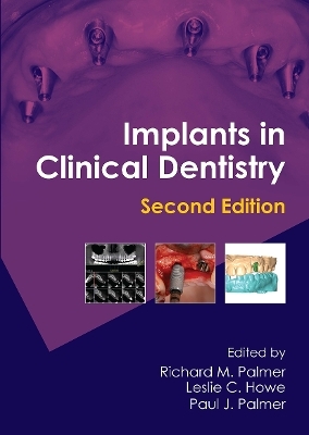 Implants in Clinical Dentistry - Richard M. Palmer, Leslie C. Howe, Paul J. Palmer