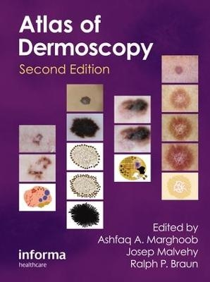 An Atlas of Dermoscopy - 