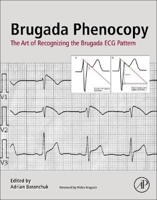 Brugada Phenocopy - 