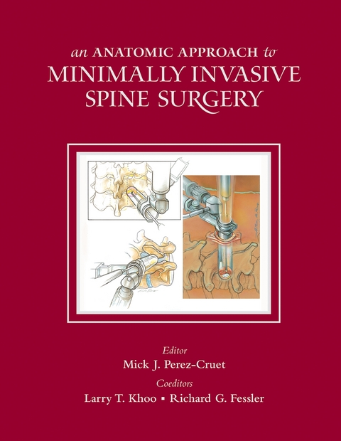 An Anatomic Approach to Minimally Invasive Spine Surgery - 