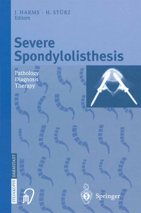 Severe Spondylolisthesis - 