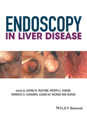 Endoscopy in Liver Disease - 