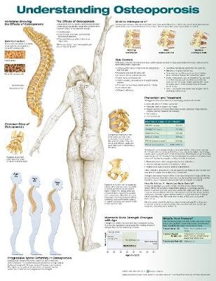 Understanding Osteoporosis Anatomical Chart