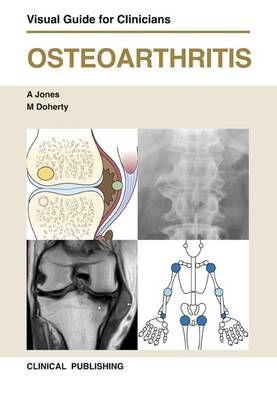 Osteoarthritis - 