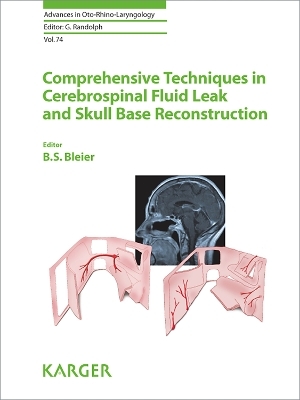 Comprehensive Techniques in CSF Leak Repair and Skull Base Reconstruction - 