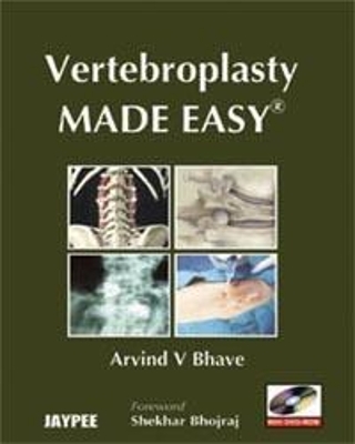 Vertebroplasty Made Easy - Arvind V Bhave