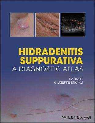 Hidradenitis Suppurativa - 