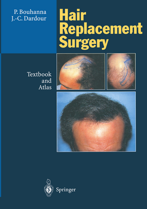 Hair Replacement Surgery - Pierre Bouhanna, Jean-Claude Dardour