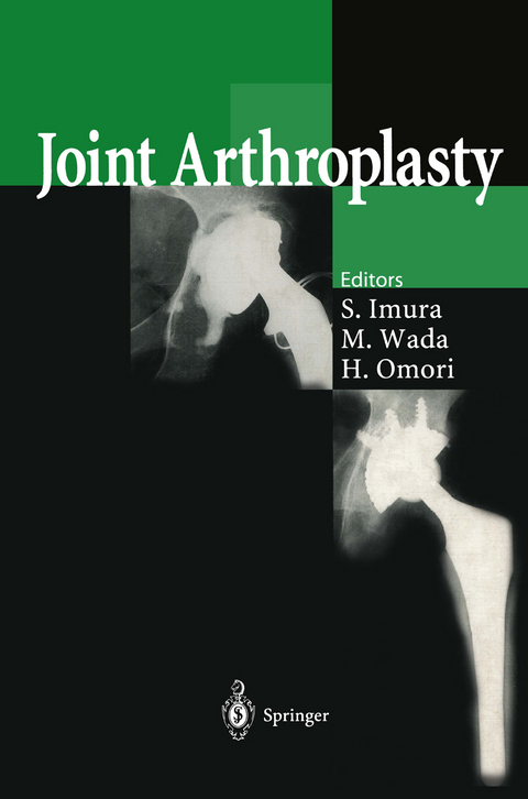 Joint Arthroplasty - 